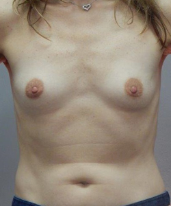 Breast Reconstruction Before - Ft. Myers FL