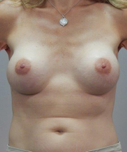 Breast Reconstruction After - Ft. Myers FL