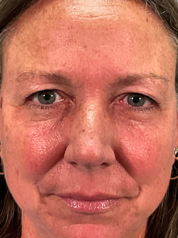 Eyelid Lift Before