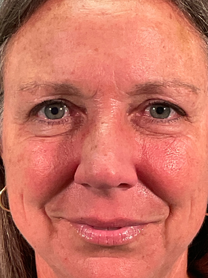 Eyelid Lift After