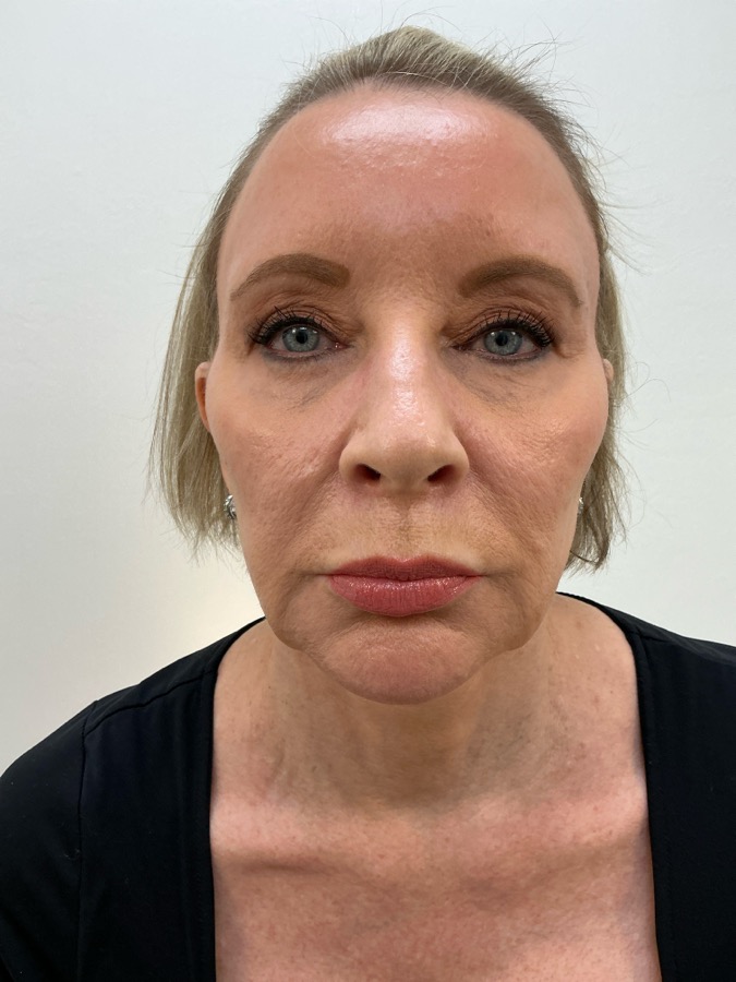 Facelift Before