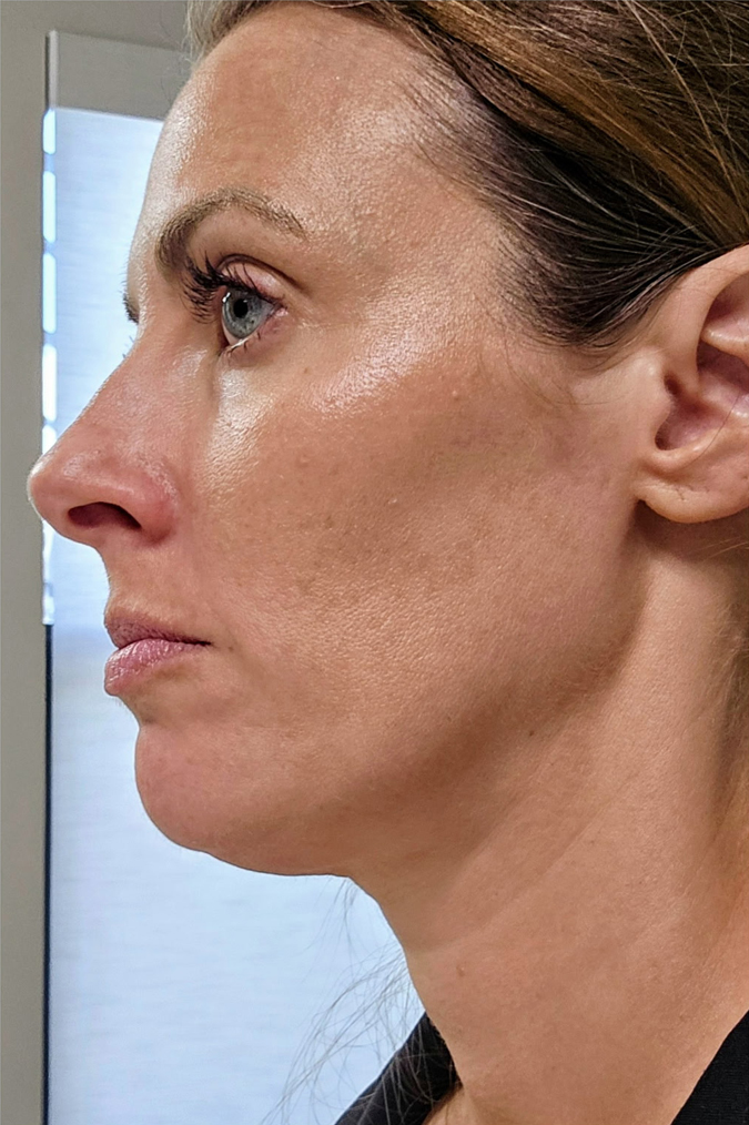 Liposuction Before