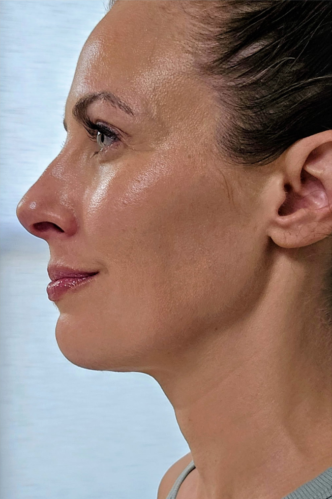 Liposuction After