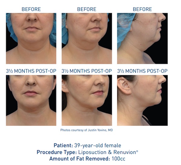 Renuvion® Before and After - Ft. Myers FL