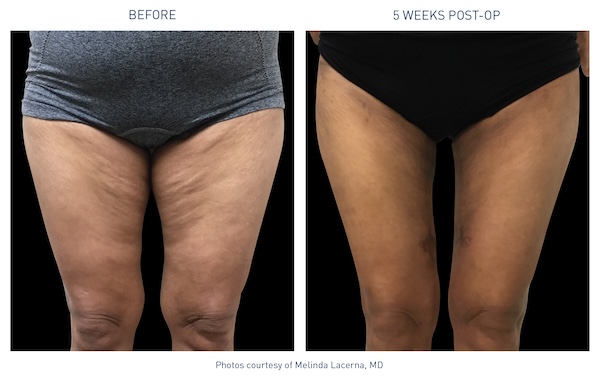 Renuvion® Before and After - Ft. Myers FL