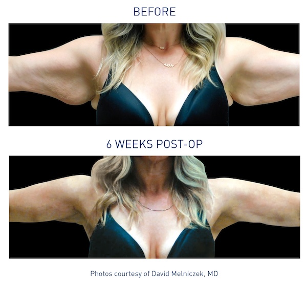 Renuvion® Before and After - Ft. Myers FL Renuvion® Before and After - Ft. Myers FL