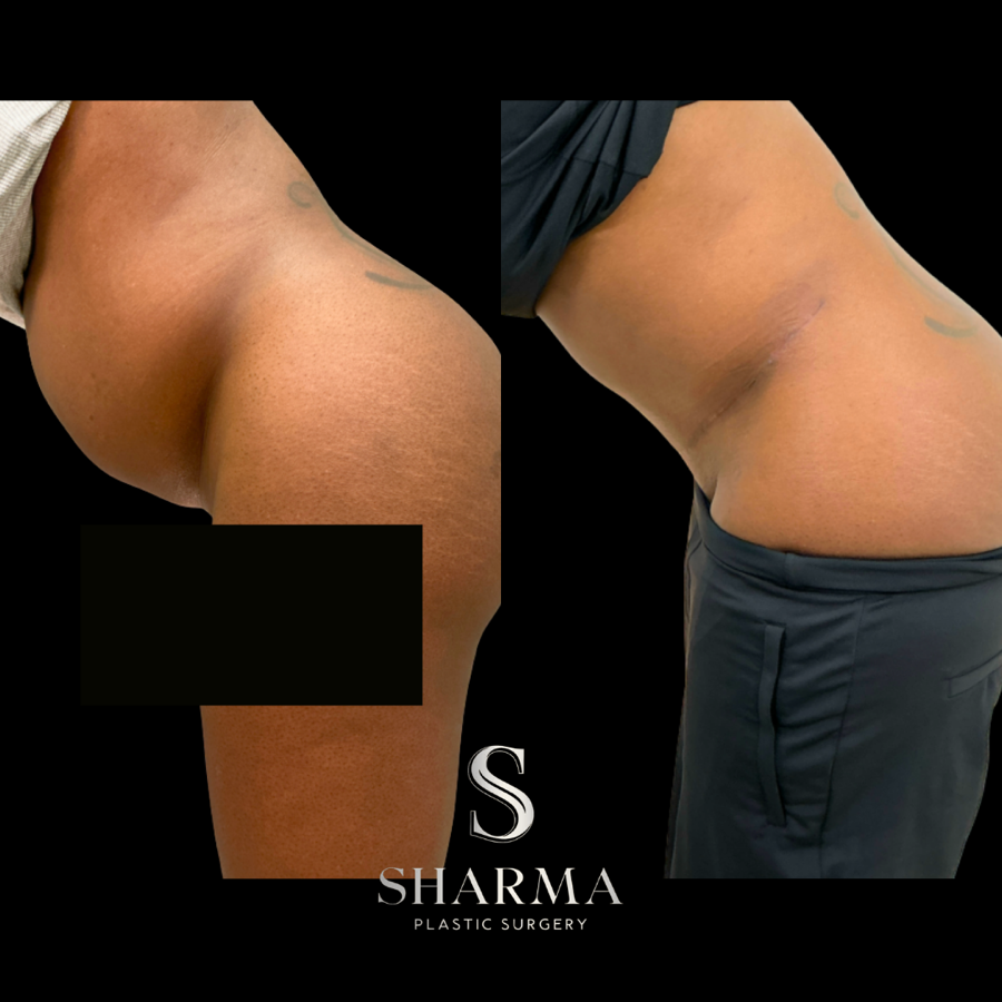 Tummy Tuck Before and After - Ft. Myers FL