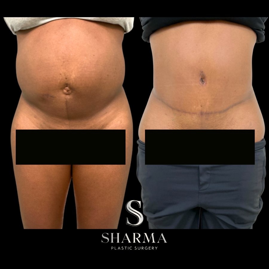 Tummy Tuck Before and After - Ft. Myers FL