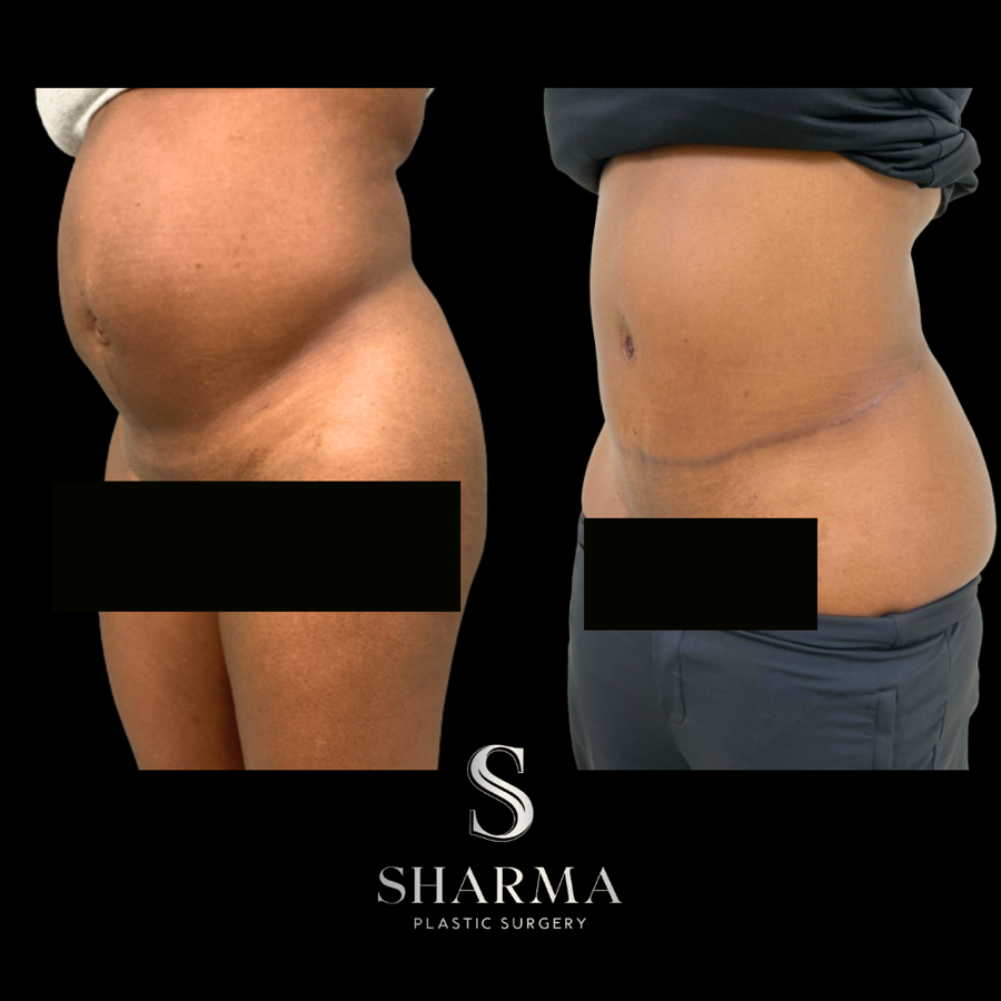 Tummy Tuck Before and After - Ft. Myers FL
