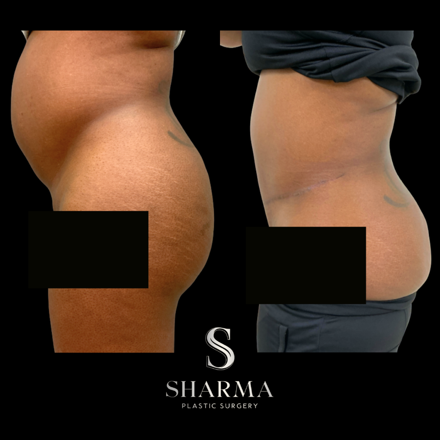 Tummy Tuck Before and After - Ft. Myers FL
