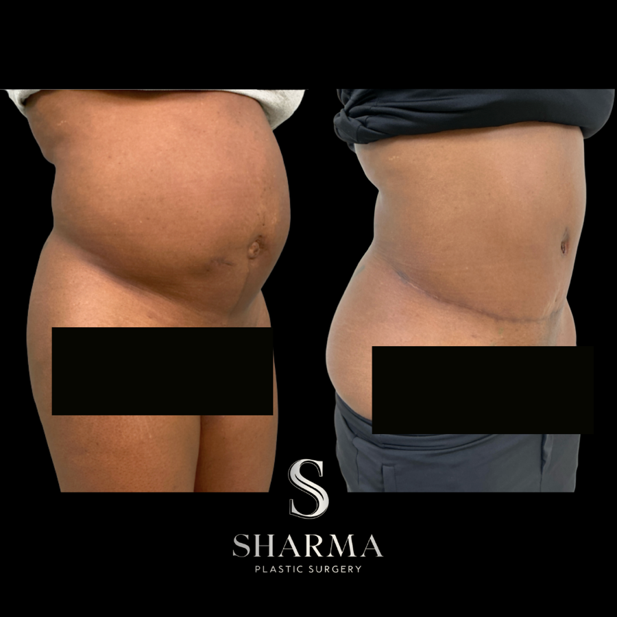 Tummy Tuck Before and After - Ft. Myers FL