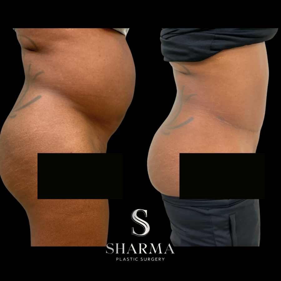 Tummy Tuck Before and After - Ft. Myers FL